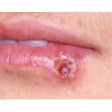 T MED HERPES PATCH cerotti labiali